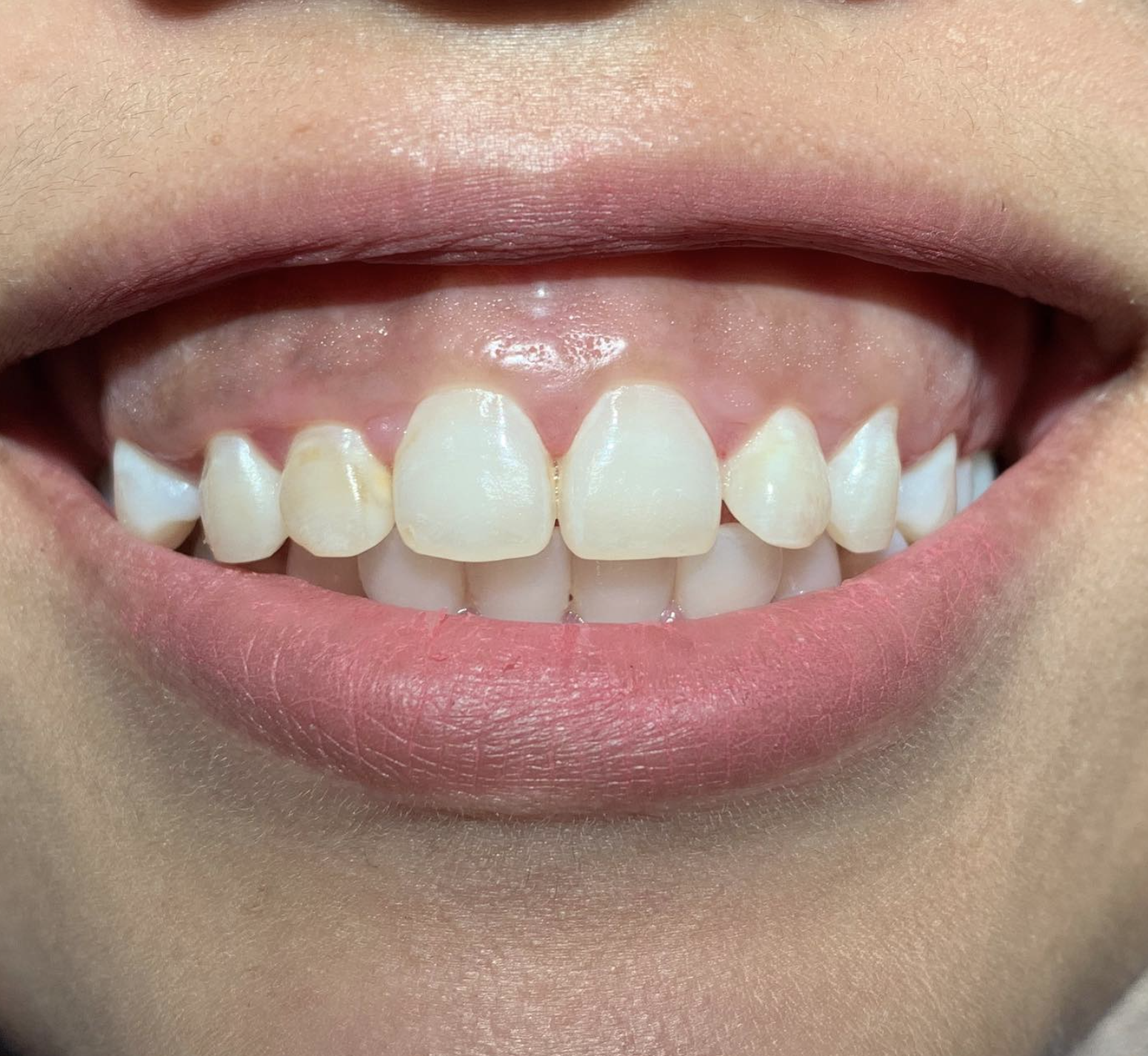 Gigi Palsu Denture
